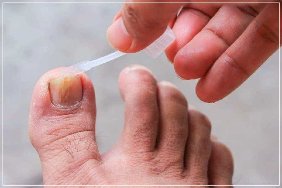 лечим грибок ногтей